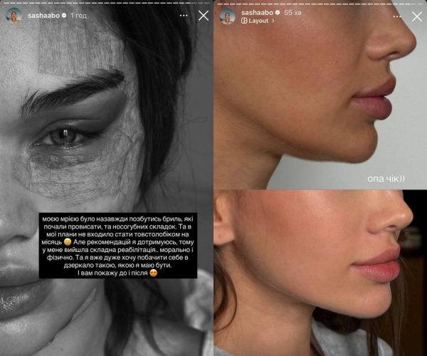 Блогер Саша Бо розповіла про пластичну операцію на обличчі та її наслідки: Мріяла про це вже давно