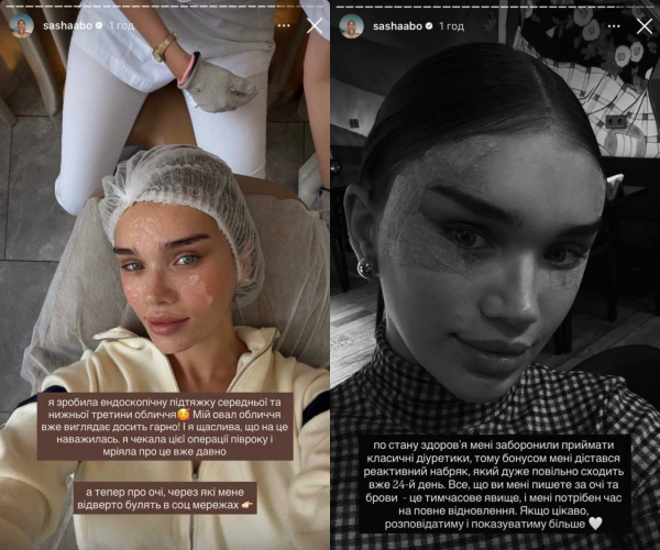 Блогер Саша Бо розповіла про пластичну операцію на обличчі та її наслідки: Мріяла про це вже давно