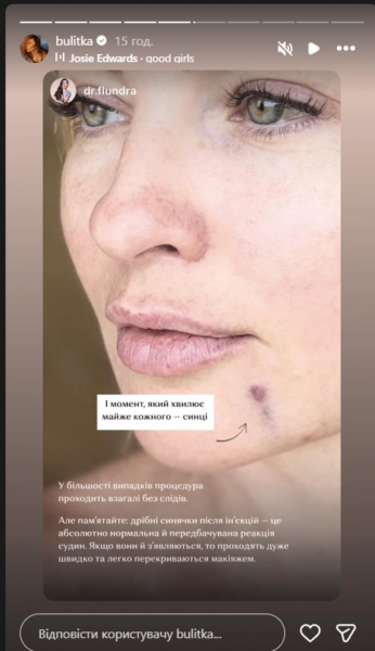 Булітко вколола філер в обличчя та показала результати до і після